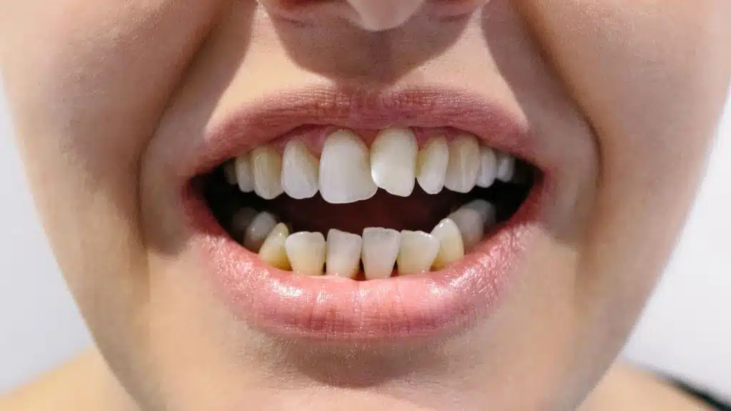 Wonky teeth