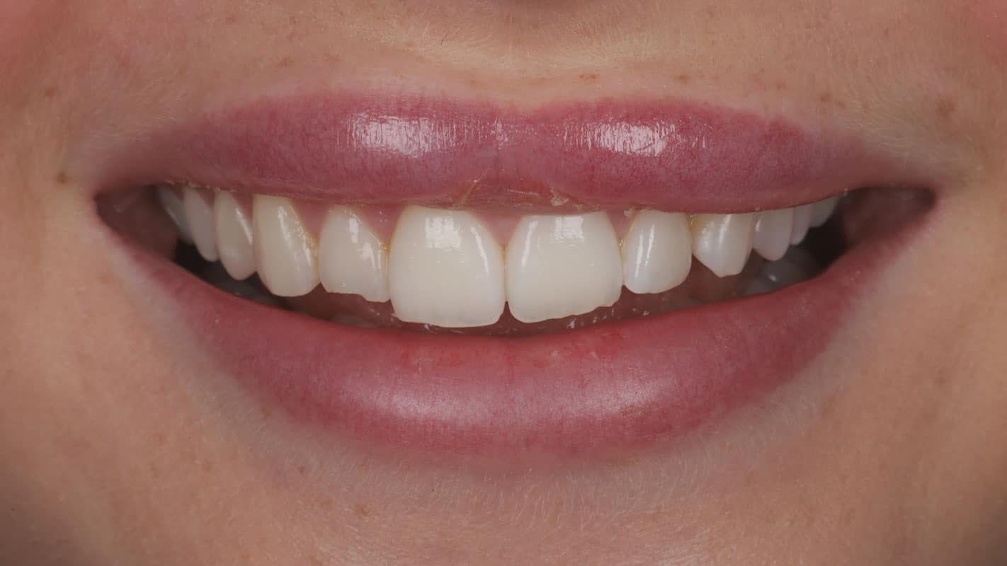 BeforeSmileTransformation