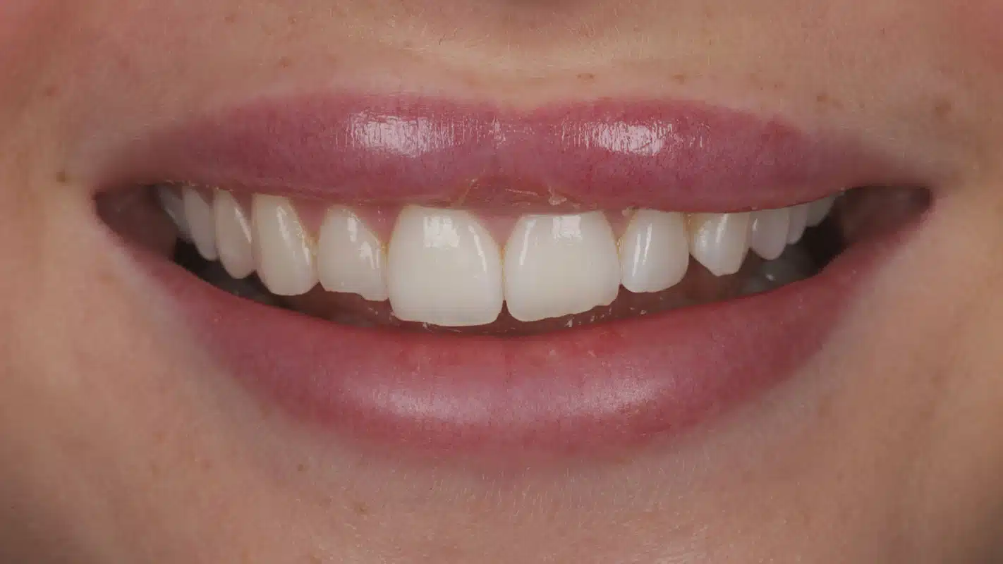 BeforeSmileTransformation