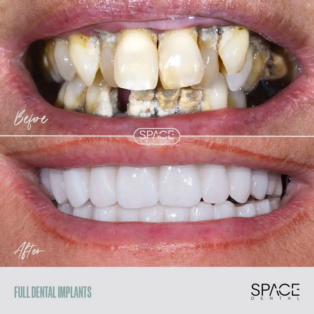 Dental Implants Sheffield - Space Dental