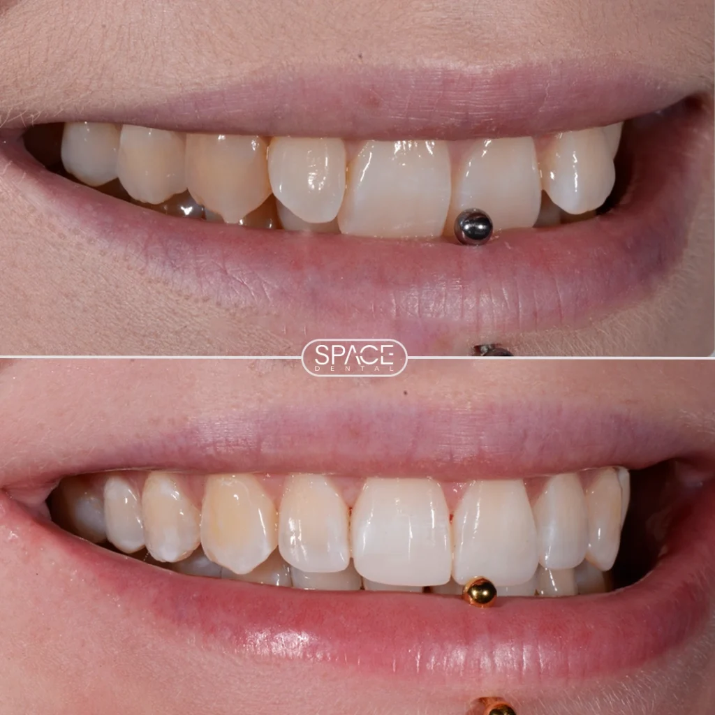 Teeth Straightening - haley 2