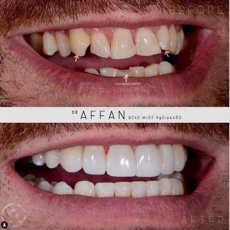 Before and after Invisalign Wakefield