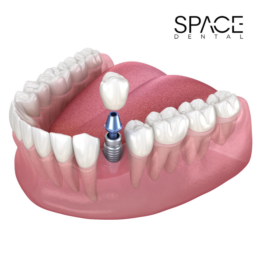 single dental implants UK