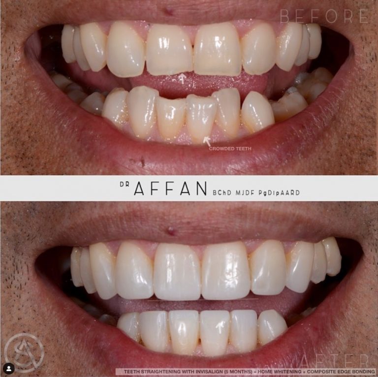 Invisalign before and after in Wakefield
